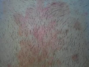 Мазь красные пятна на лобке