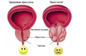 Будь здоров простата