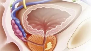 Фиброзные изменения предстательной железы что это такое лечение