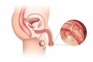 Урологическое заболевание молочница википедия