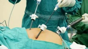 Задержка после лапароскопии эндометриоза