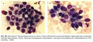 Дисплазия шейки матки цитологическое исследование