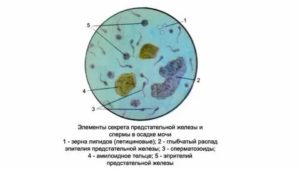 Что такое лецитиновые зерна в анализе секрета предстательной железы