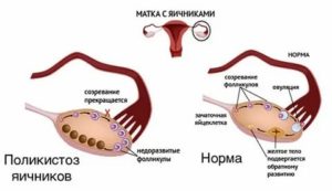 Как стимулировать овуляцию при поликистозе яичников народными средствами