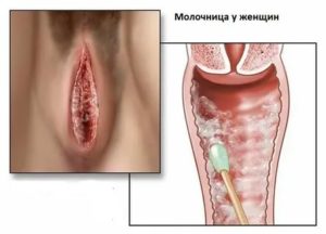 Молочница хлопьями вываливается чешется