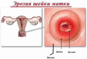 Что такое эрозия шейки матки перед месячными