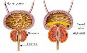 История болезни при аденоме простаты