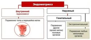 Наружный генитальный эндометриоз симптомы и лечение