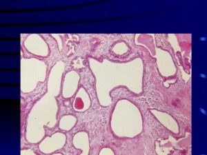 Препараты при аденоме молочной железы