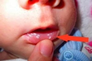 Может быть молочница и стоматит одновременно