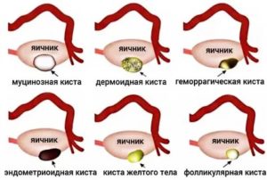 Какие бывают кисты яичника виды и симптомы
