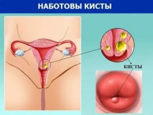 Как лечить кисту на шейке матки алоэ и медом
