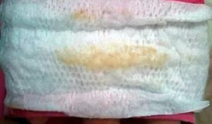 Жидкие выделения при молочнице на 35 неделе беременности