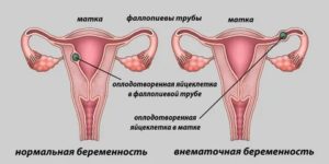 Что может болеть во время месячных маточные трубы