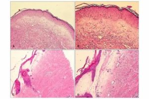 Препараты для лечения лейкоплакии вульвы