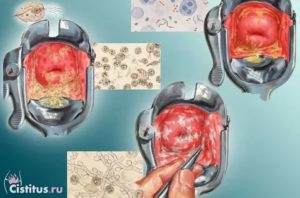 Может ли быть кровянистые выделения при кистах шейки матки