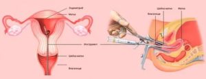 Аспирация эндометрия с цитологическим исследованием