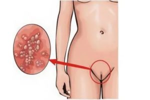 Уреаплазма и кандидоз у женщин лечение