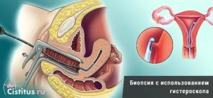 Что лучше гистероскопия или пайпель биопсия эндометрия что это такое