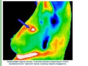 Термография при раке молочной железы