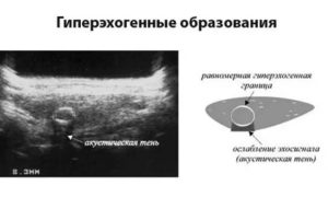 Гипоэхогенное образование в матке по узи