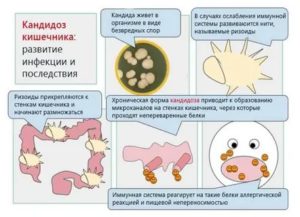 Молочница в кишечнике у грудничка симптомы и лечение