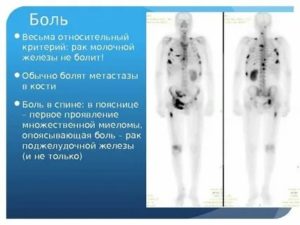 Продолжительность жизни при метастазах в костях при раке молочной железы