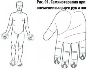 Семянотерапия су джок при бесплодии