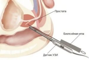 Биопсия предстательной железы тур-биопсия предстательной железы