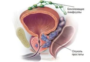 Что такое тумор простаты