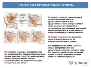 Голодание при раке предстательной железы