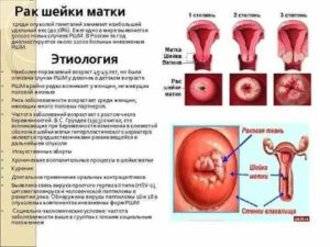 Опухоль шейки матки на ощупь