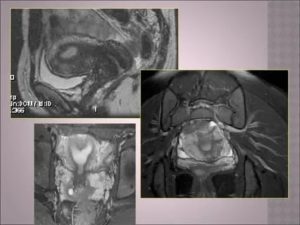 Что может показать мрт в гинекологии