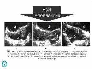 Что такое перитонит при кисте яичника