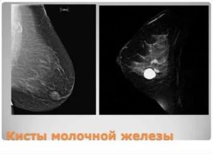 Можно ли при кисте молочной железы заниматься спортом
