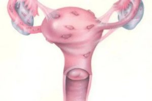 Можно ли делать стимуляцию при эндометриозе