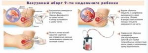 Могут ли начаться месячные при замершей беременности