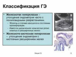 Что это такое железисто-кистозная гиперплазия эндометрия и как лечить