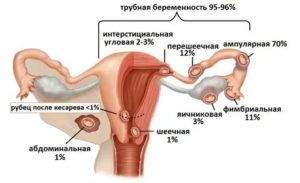 Может ли быть внематочная беременность при месячных и какие симптомы