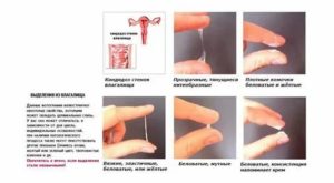 Молочница у меня и у мужа как лечить отзывы