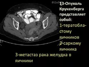 Метастазы в яичниках при раке желудка прогноз