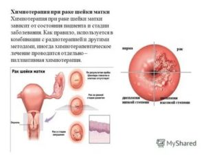 Последствия после химиотерапии при раке шейки матки 4 стадии
