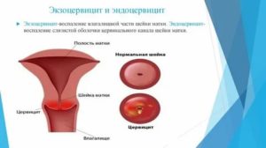 Лечение эндоцервицита при климаксе