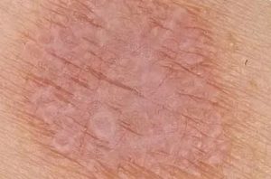 После антибиотиков шелушится член