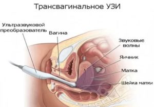 Как делают узи матки и придатков у девственниц