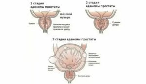 Излечима ли аденома предстательной железы мнение ученых