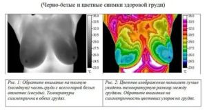 Термография при раке молочной железы