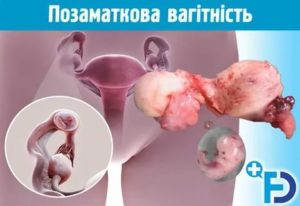 Что может болеть во время месячных маточные трубы