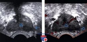 Гипоэхогенное образование предстательной железы это рак или нет
