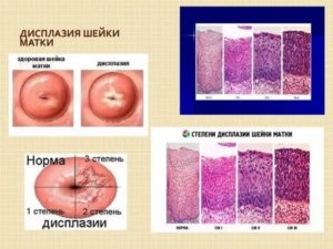 Какими препаратами лечить дисплазию шейки матки 1 степени
